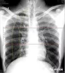 “如何安全、专业地查看胸片曝光：实用指南”