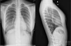 “如何安全、专业地查看胸片曝光：实用指南”