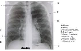 “如何安全、专业地查看胸片曝光：实用指南”