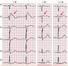 ST段抬高在V2、V3、V4导联中的意义