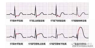 ST段抬高在V2、V3、V4导联中的意义