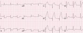 ST段抬高在V2、V3、V4导联中的意义
